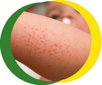 Rashes & spots (pictures) in toddlers, children & babies - NHS doctor  identified