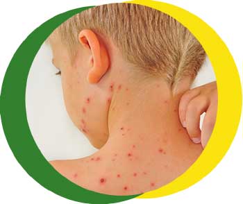 Chickenpox - NHS Nottingham and Nottinghamshire ICB