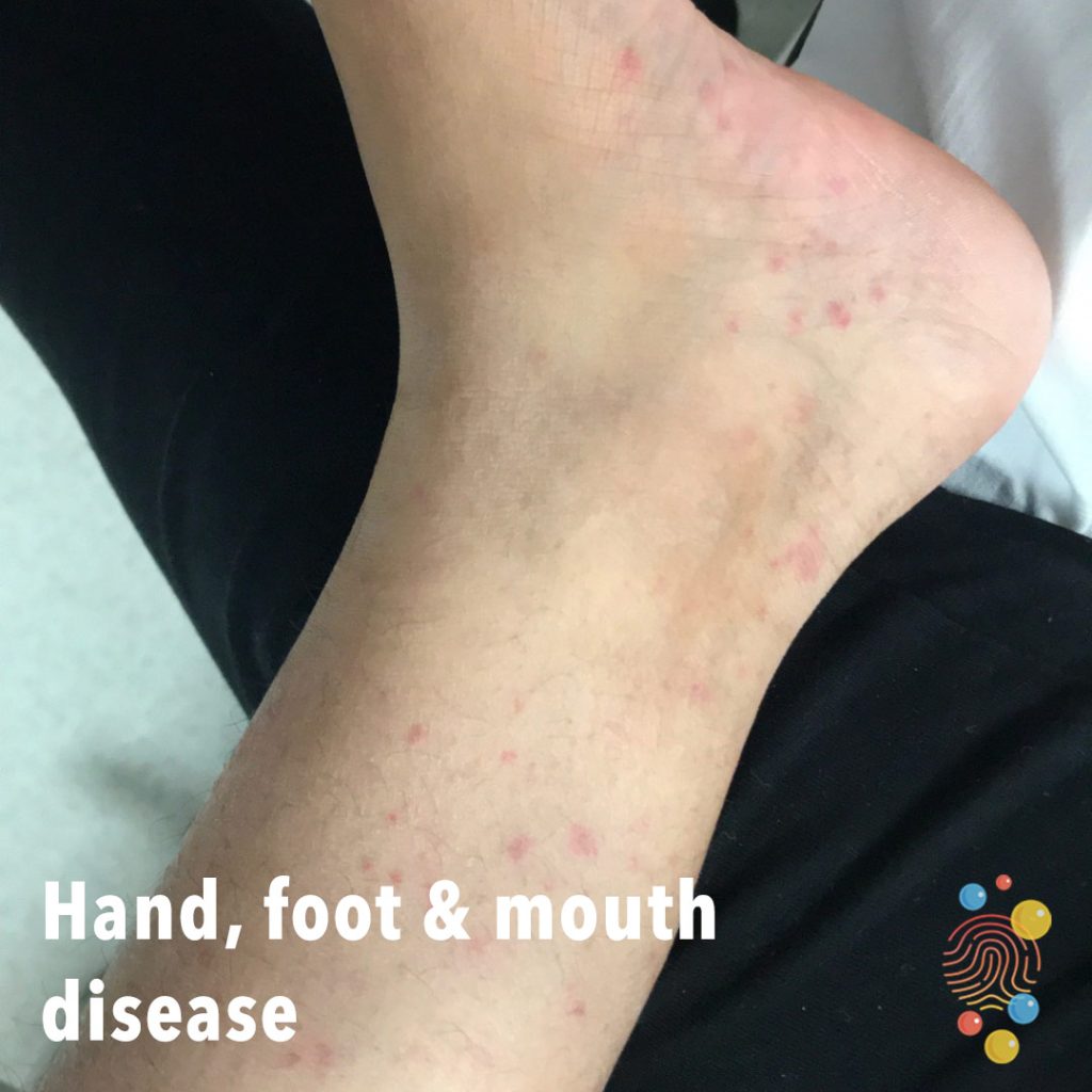 Hand, foot and mouth disease - NHS Nottingham and Nottinghamshire ICB