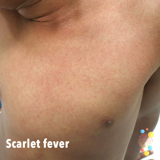 Managing scarlet fever