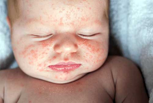 My baby has a rash - NHS Nottingham and Nottinghamshire ICB