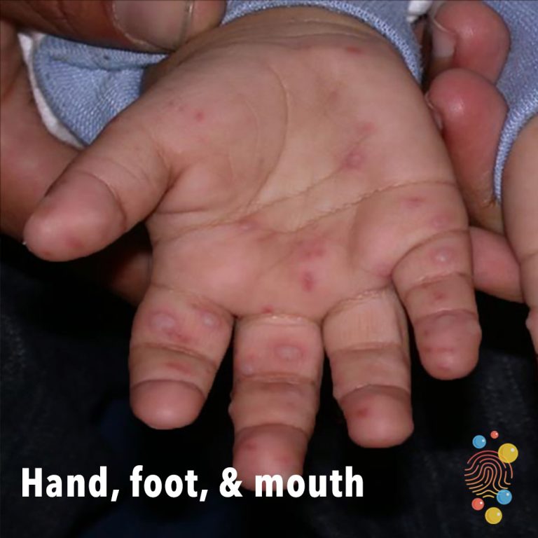 Hand, foot and mouth disease NHS Nottingham and Nottinghamshire ICB