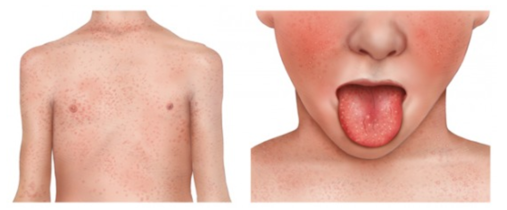 Scarlet fever - NHS